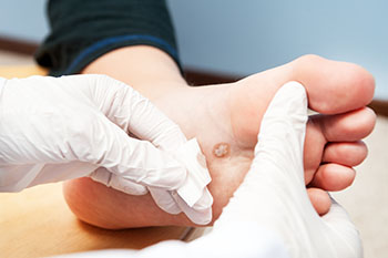 wart treatment by doctor